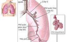 Tại sao viêm phế quản phổi ở trẻ em lại nguy hiểm?